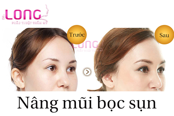 nang-mui-boc-sun-nhan-tao-co-dau-khong-1