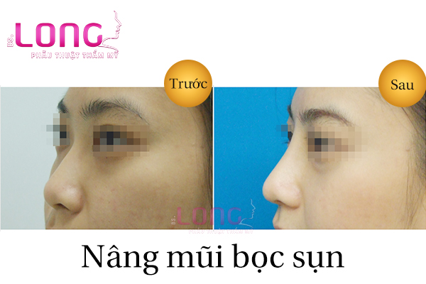 nang-mui-boc-sun-nhan-tao-o-dau-tot