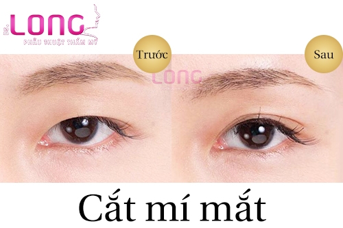 tim-hieu-ve-phuong-phap-cat-mat-2-mi-han-quoc-2