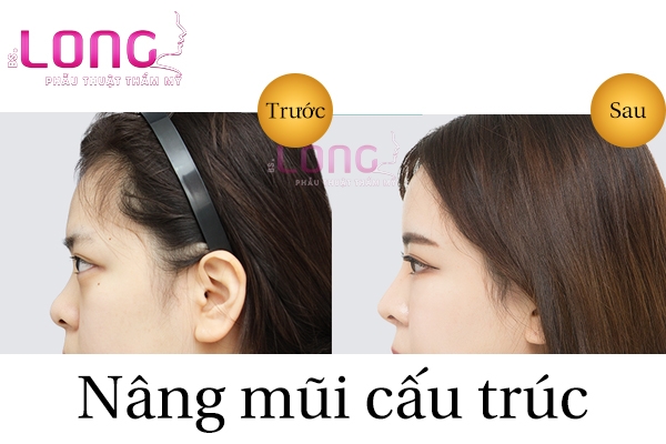 review-qua-trinh-phau-thuat-nang-mui-cau-truc-1