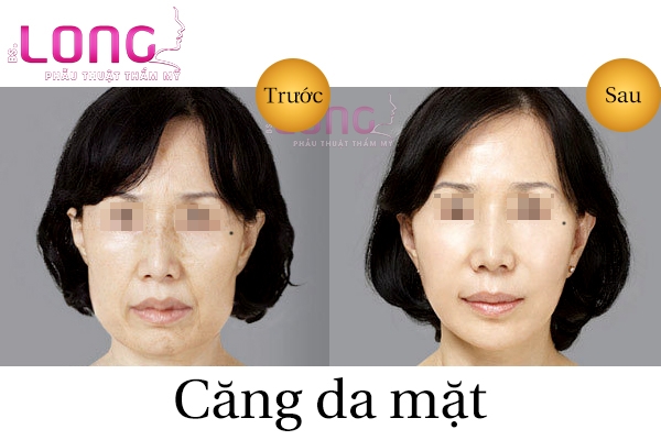 Can-da-mat-tu-nhien-bang-chi-khong-phau-thuat-1