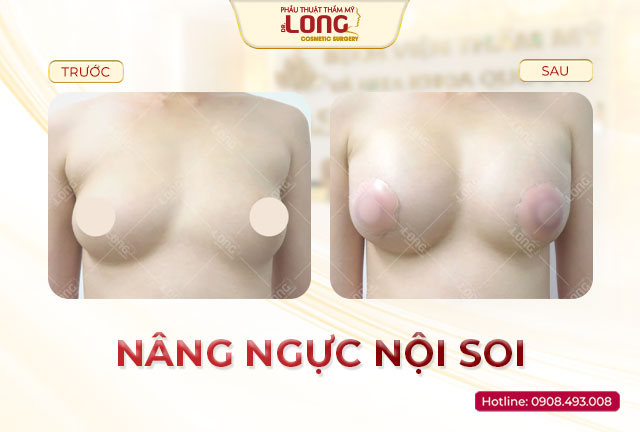 nang-nguc-noi-soi-bacsilong
