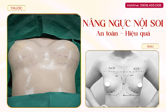 nang-nguc-noi-soi-an-toàn-hiệu-quả
