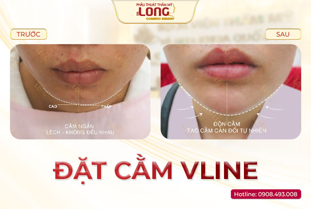 don-cam-vline-bacsilong