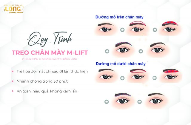 quy trình treo chân mày M-lift