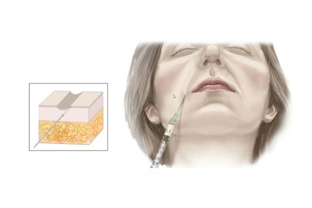 Kỹ thuật ghép mỡ rãnh mũi má