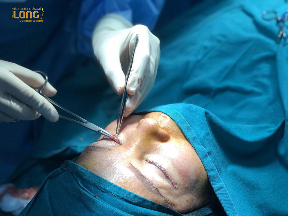 Phẫu thuật mí mắt là phẫu thuật tạo hình mí mắt