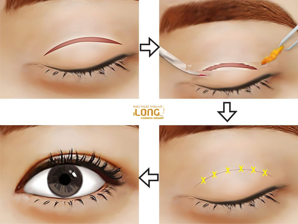 Phẫu thuật cắt mí mắt một phần có đường rạch ngắn