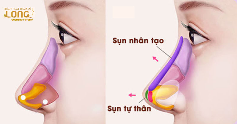 Nâng mũi bán cấu trúc giúp chỉnh sửa dáng mũi ít khuyết điểm