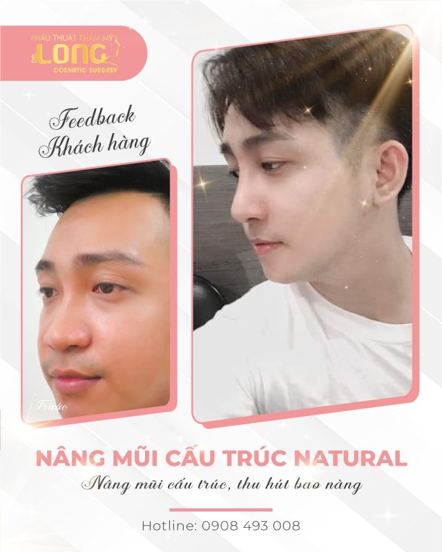nang-mui-cau-truc-nam