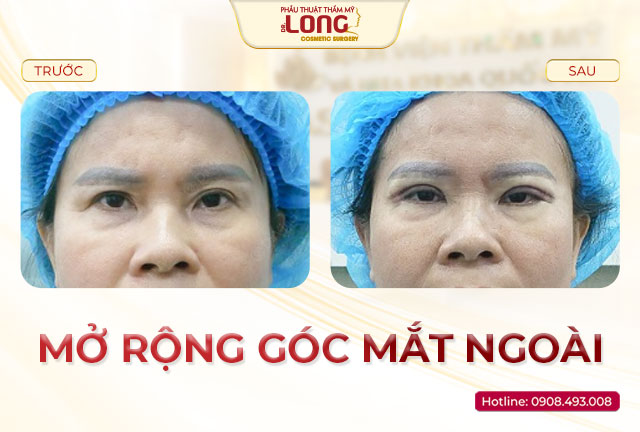 mo-rong-goc-mat