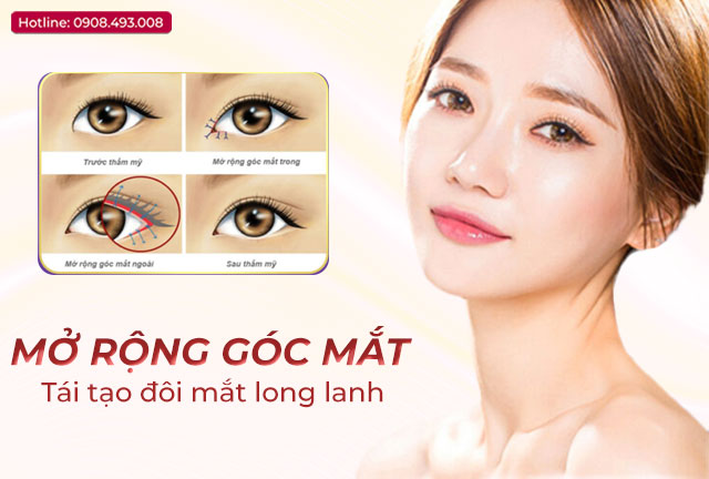 mo-rong-goc-mat
