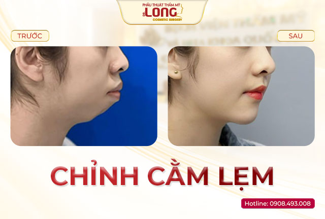 chinh-cam-lem-bacsilong