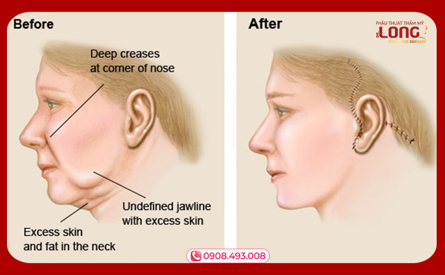Phương pháp căng da mặt này an toàn và có thời gian phục hồi nhanh hơn căng da truyền thống