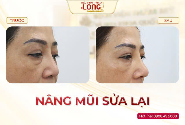 chinh-mui-hu-bacsilong