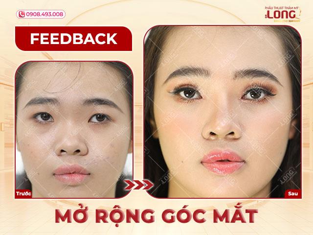 Mở rộng góc mắt trong cho những trường hợp có kích thước mắt nhỏ