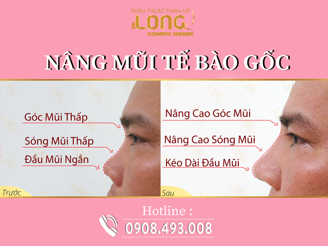 Nâng mũi tế bào gốc cho nam