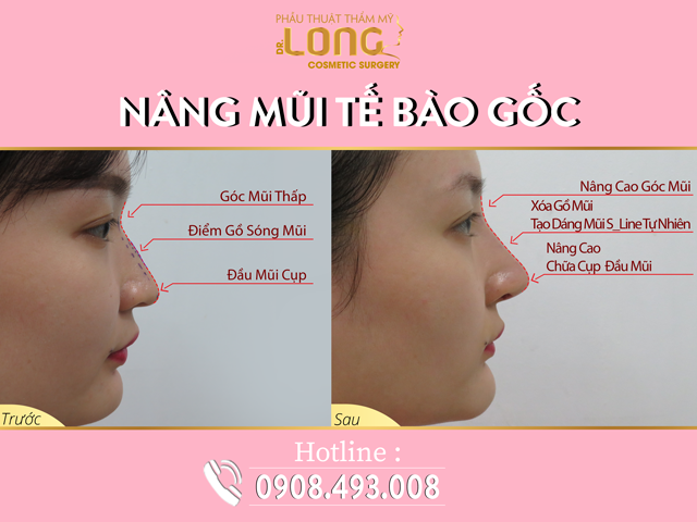 Nâng mũi tế bào gốc dáng cao tây