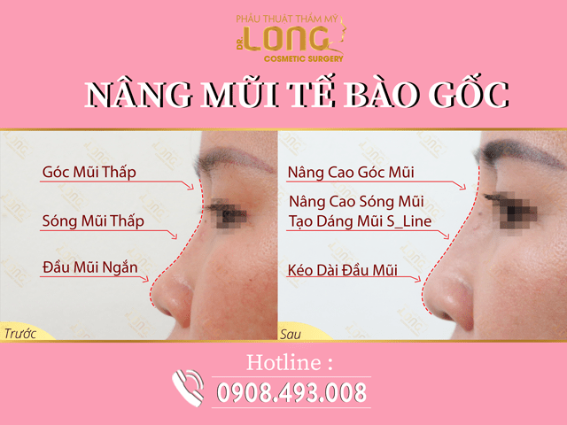 Nâng mũi tế bào gốc dáng sline