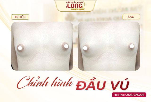chinh-hinh-dau-vu