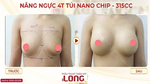 nang-nguc-nanochip