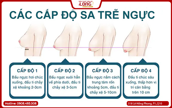 cap-do-sa-tre-nguc