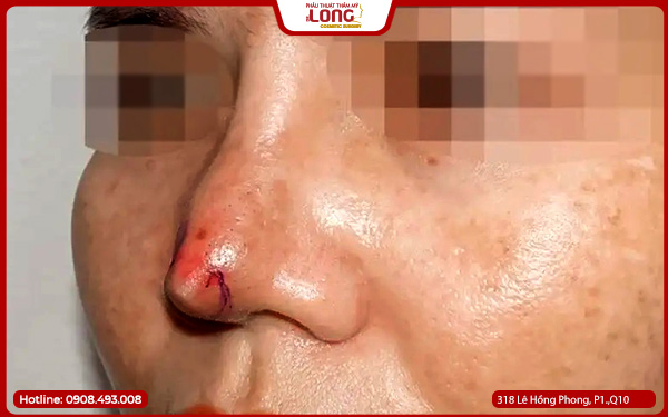 dau-hieu-sua-song-mui-bi-hong