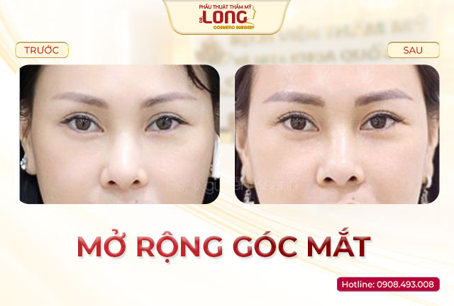 mo-rong-goc-mat_chi-lan