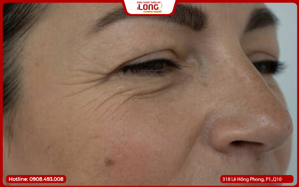 lay-bong-mo-mat-cho-nguoi-lon-tuoi