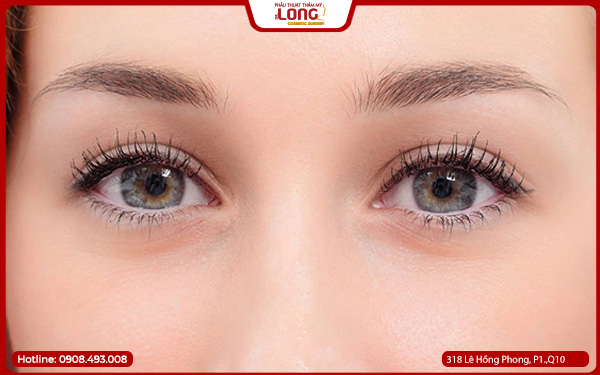 Mở rộng góc mắt bao lâu thì ổn định