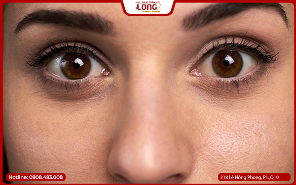 Mở rộng góc mắt cho mắt một mí