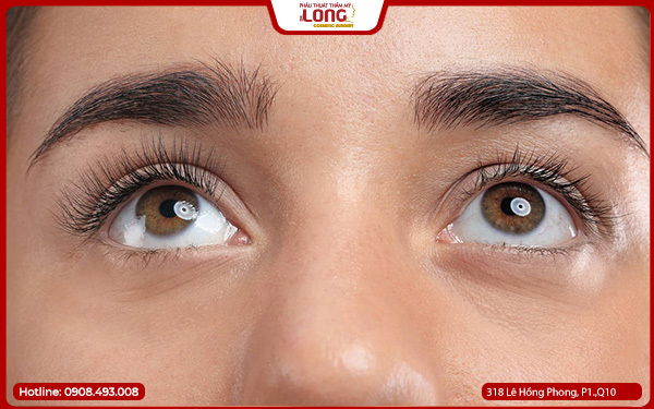 mo-rong-goc-mat-gia-bao-nhieu