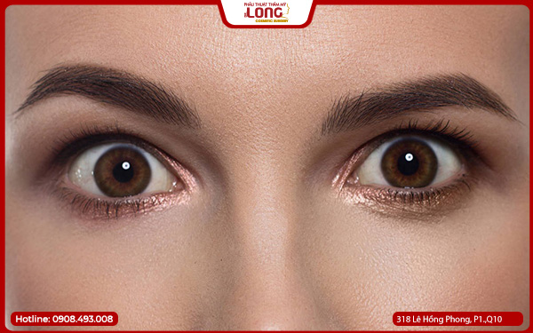 mo-rong-goc-mat-gia-re