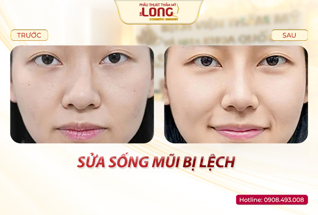 sua-song-mui-lech