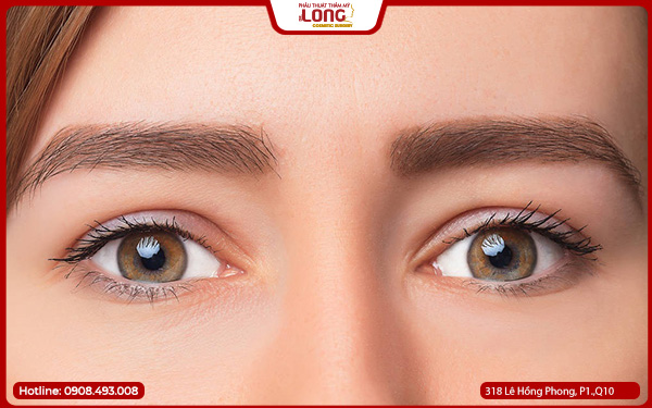 Ai nên thực hiện lấy bọng mỡ mắt