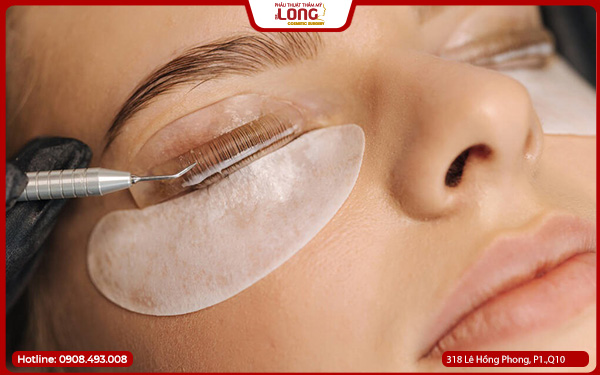 Cắt mí hồi phục bao lâu