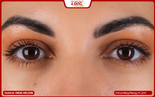 Lưu ý sau khi mở rộng góc mắt