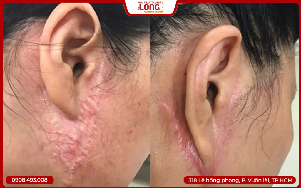ảnh-sẹo-căng-da-khong-đúng-kỹ-thuật