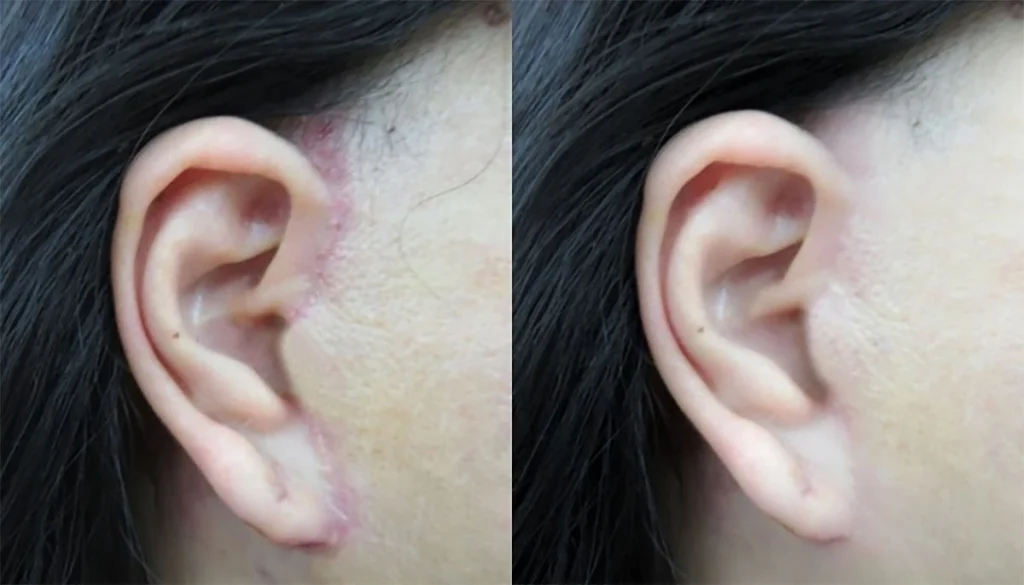 kỹ thuật căng da mặt multilayer