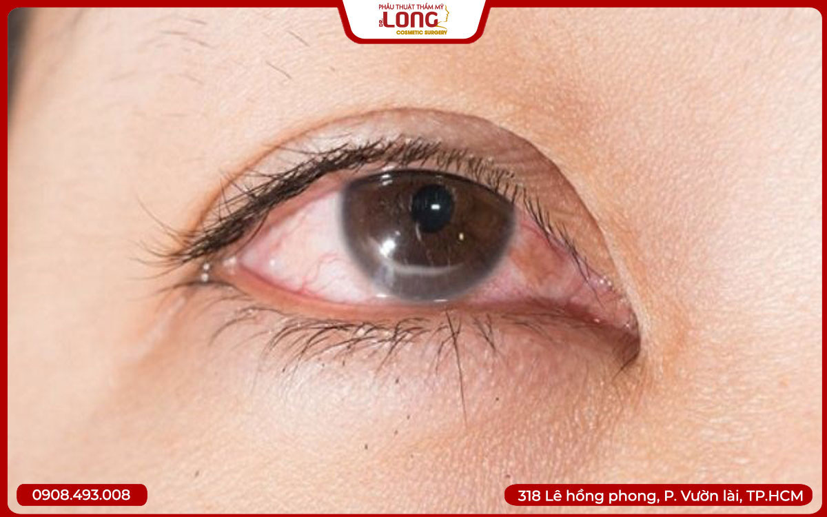 nhấn-mí-xong-về-chảy-nước-mắt