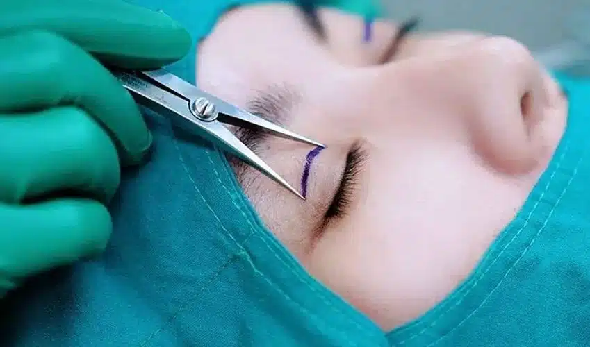 cắt mí mắt sau bao lâu đụng nước được