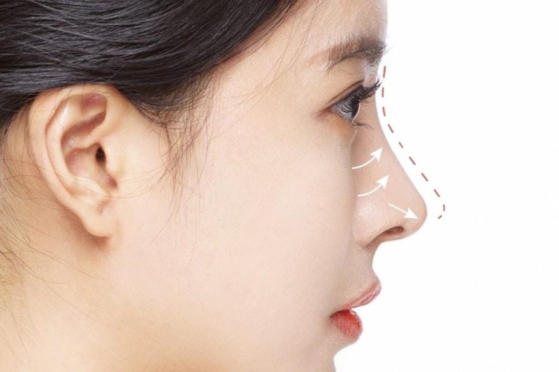 nâng mũi cấu trúc 2